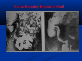 Crohn Hastalığı-Baryumlu Grafi 
 