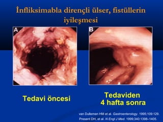 İnfliksimabla dirençli ülser, fistüllerin 
iyileşmesi 
Tedavi öncesi Tedaviden 
4 hafta sonra 
van Dullemen HM et al. Gastroenterology. 1995;109:129. 
Present DH, et al. N Engl J Med. 1999;340:1398–1405. 
 
