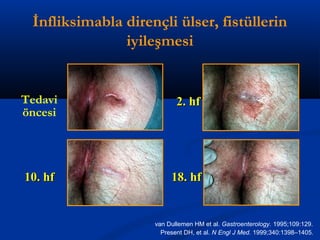 İnfliksimabla dirençli ülser, fistüllerin 
Tedavi 
öncesi 
iyileşmesi 
22.. hhff 
1100.. hhff 1188.. hhff 
van Dullemen HM et al. Gastroenterology. 1995;109:129. 
Present DH, et al. N Engl J Med. 1999;340:1398–1405. 
 