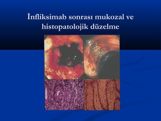 İnfliksimab sonrası mukozal ve 
histopatolojik düzelme 
 