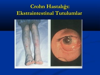 CCrroohhnn HHaassttaallıığğıı:: 
EEkkssttrraaiinntteessttiinnaall TTuuttuulluummllaarr 
 