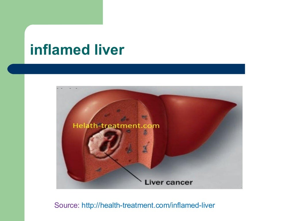 Inflamed liver