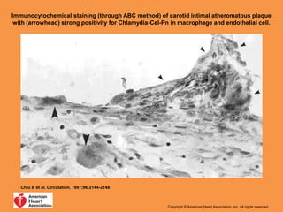 Immunocytochemical staining (through ABC method) of carotid intimal atheromatous plaque
with (arrowhead) strong positivity for Chlamydia-Cel-Pn in macrophage and endothelial cell.
Chiu B et al. Circulation. 1997;96:2144-2148
Copyright © American Heart Association, Inc. All rights reserved.
 
