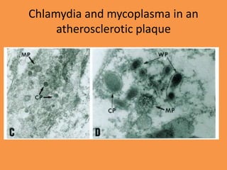 Chlamydia and mycoplasma in an
atherosclerotic plaque
 