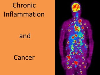 Chronic
Inflammation
and
Cancer
 