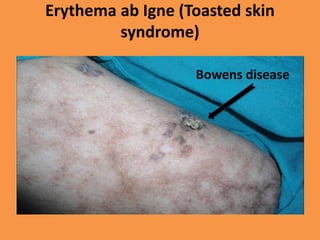 Erythema ab Igne (Toasted skin
syndrome)
Bowens disease
 