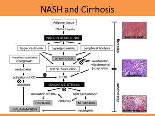 NASH and Cirrhosis
 