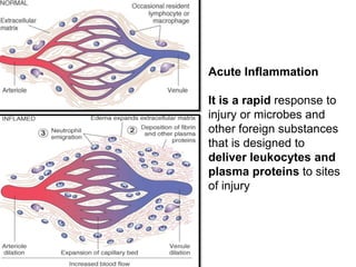 Acute Inflammation
It is a rapid response to
injury or microbes and
other foreign substances
that is designed to
deliver leukocytes and
plasma proteins to sites
of injury
 