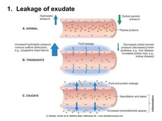 1. Leakage of exudate
 