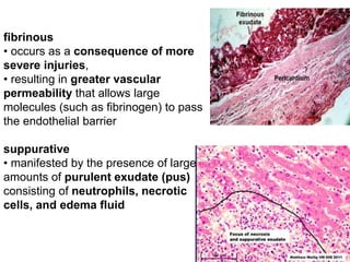 fibrinous
• occurs as a consequence of more
severe injuries,
• resulting in greater vascular
permeability that allows large
molecules (such as fibrinogen) to pass
the endothelial barrier
suppurative
• manifested by the presence of large
amounts of purulent exudate (pus)
consisting of neutrophils, necrotic
cells, and edema fluid
 