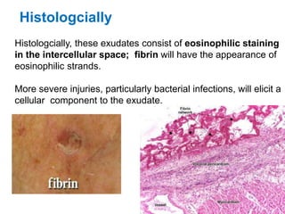 Histologcially, these exudates consist of eosinophilic staining
in the intercellular space; fibrin will have the appearance of
eosinophilic strands.
More severe injuries, particularly bacterial infections, will elicit a
cellular component to the exudate.
Histologcially
 