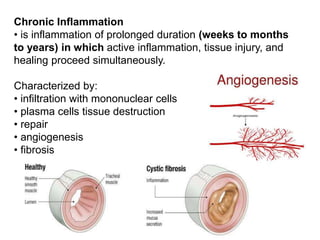 Chronic Inflammation
• is inflammation of prolonged duration (weeks to months
to years) in which active inflammation, tissue injury, and
healing proceed simultaneously.
Characterized by:
• infiltration with mononuclear cells
• plasma cells tissue destruction
• repair
• angiogenesis
• fibrosis
 