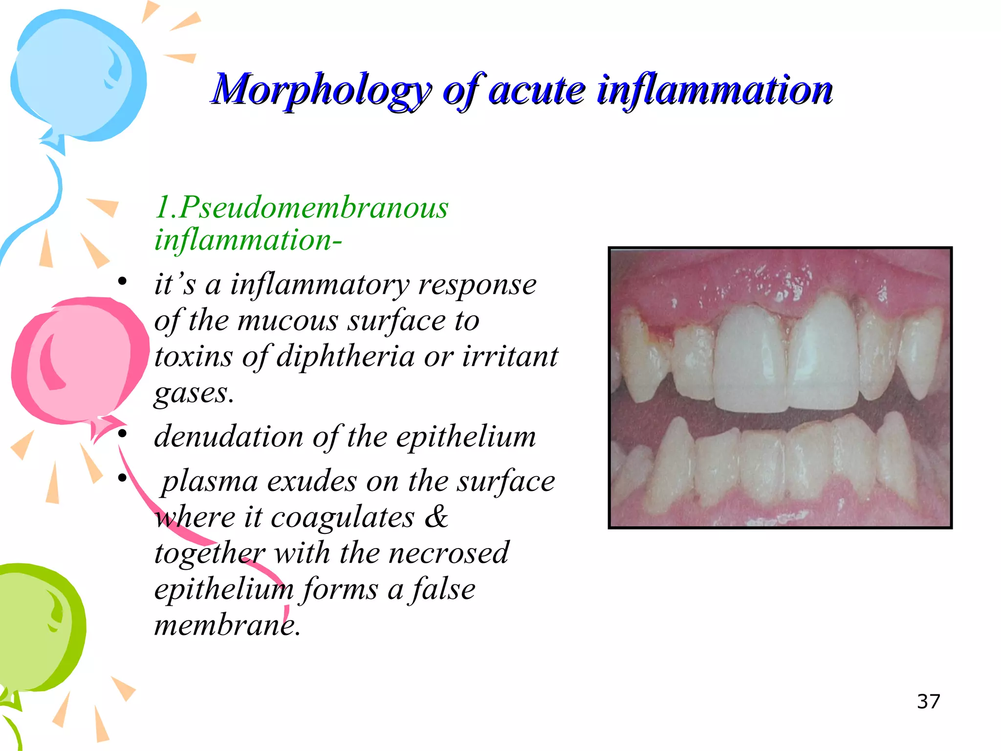 Morphology of acute inflammationMorphology of acute inflammation
1.Pseudomembranous
inflammation-
• it’s a inflammatory response
of the mucous surface to
toxins of diphtheria or irritant
gases.
• denudation of the epithelium
• plasma exudes on the surface
where it coagulates &
together with the necrosed
epithelium forms a false
membrane.
37
 