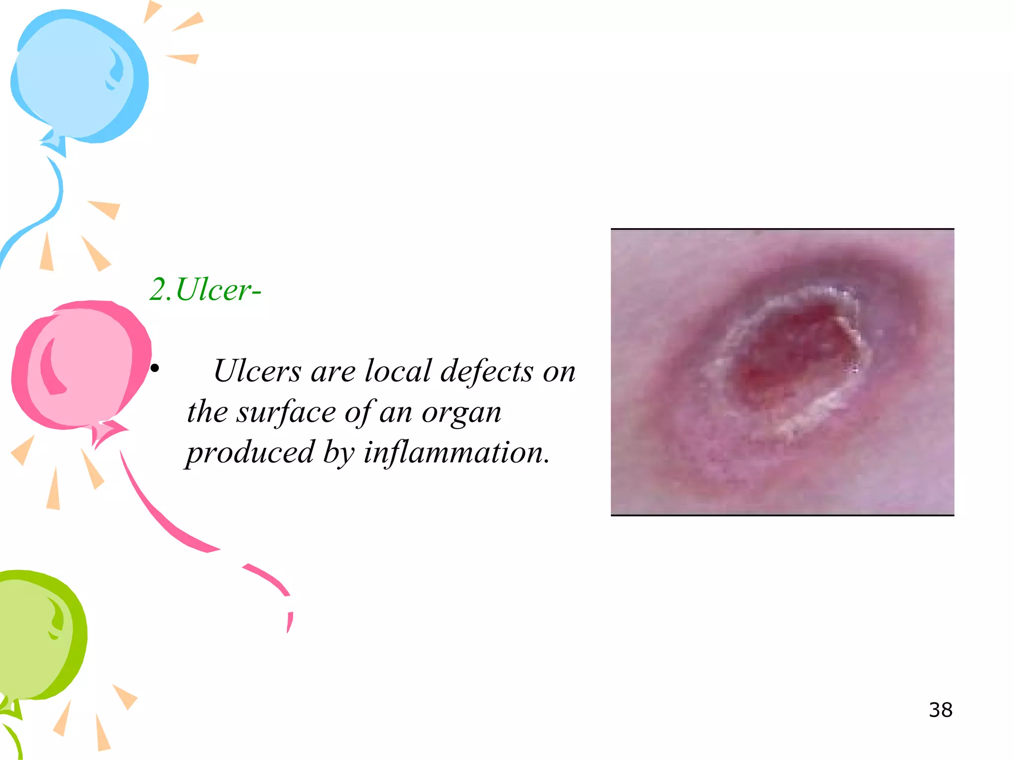 2.Ulcer-
• Ulcers are local defects on
the surface of an organ
produced by inflammation.
38
 