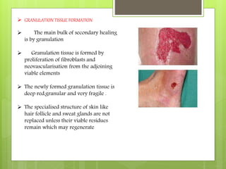 Inflammation and wound healing | PPTX