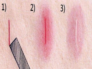 Inflammation | PPTX