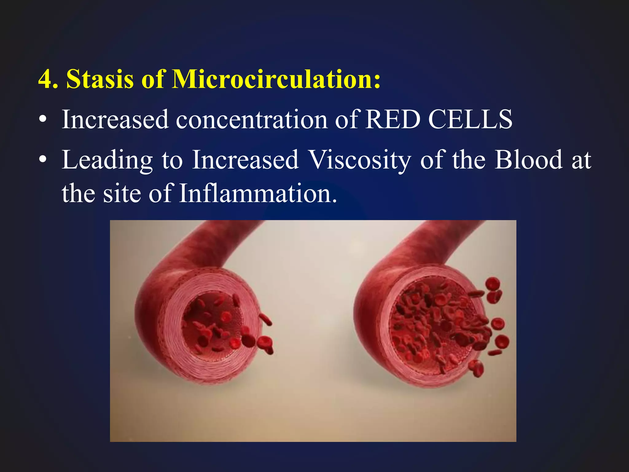 4. Stasis of Microcirculation:
• Increased concentration of RED CELLS
• Leading to Increased Viscosity of the Blood at
the site of Inflammation.
 