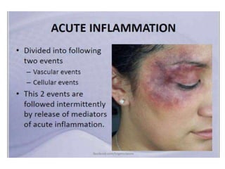 Inflammation