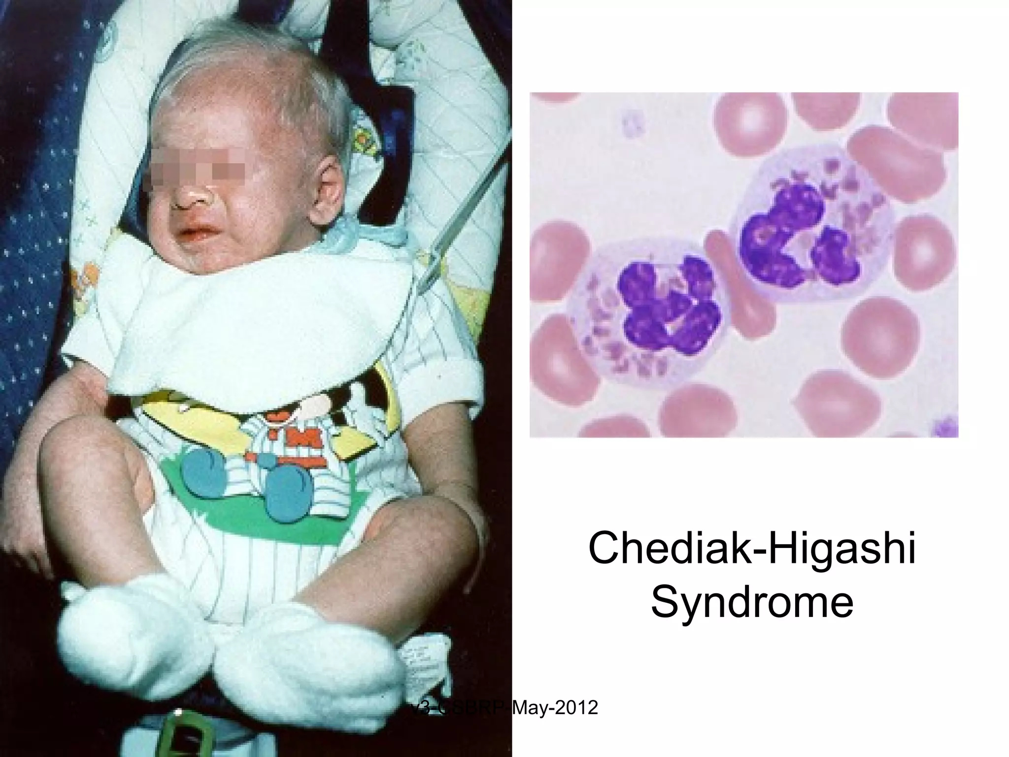Chediak-Higashi
                 Syndrome

v3-CSBRP-May-2012
 
