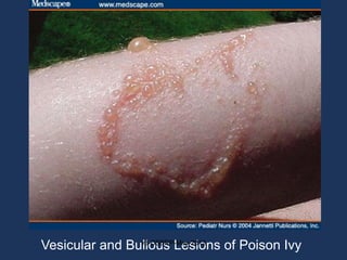 Vesicular and Bullous Lesions of Poison Ivy
                v3-CSBRP-May-2012
 