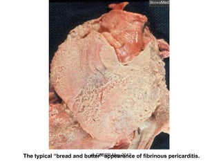 The typical “bread and butter” appearance of fibrinous pericarditis.
                         v3-CSBRP-May-2012
 