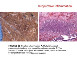 Suppurative inflammation




FIGURE 2-20 Purulent inflammation. A, Multiple bacterial
abscesses in the lung, in a case of bronchopneumonia. B, The
abscess contains neutrophils and cellular debris, and is surrounded
by congested blood vessels.v3-CSBRP-May-2012
 