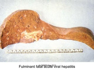 v3-CSBRP-May-2012
Fulminant fatal acute viral hepatitis
 