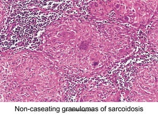 Non-caseating granulomas of sarcoidosis
               v3-CSBRP-May-2012
 