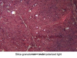 Silica granulomas – under polarized light
              v3-CSBRP-May-2012
 