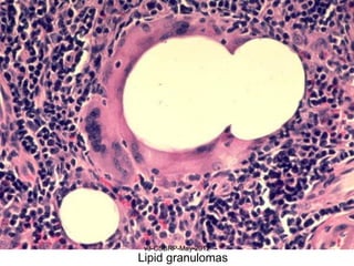 v3-CSBRP-May-2012
Lipid granulomas
 