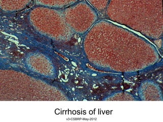 Cirrhosis of liver
   v3-CSBRP-May-2012
 