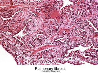 Pulmonary fibrosis
   v3-CSBRP-May-2012
 