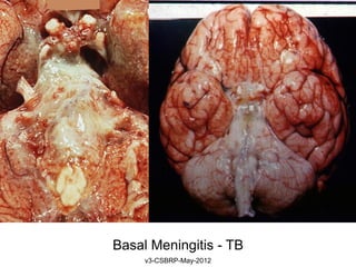 Basal Meningitis - TB
     v3-CSBRP-May-2012
 