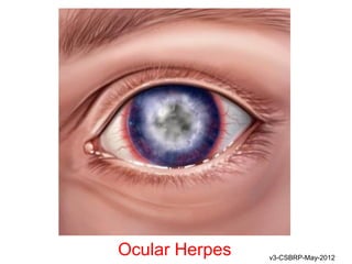 Ocular Herpes   v3-CSBRP-May-2012
 