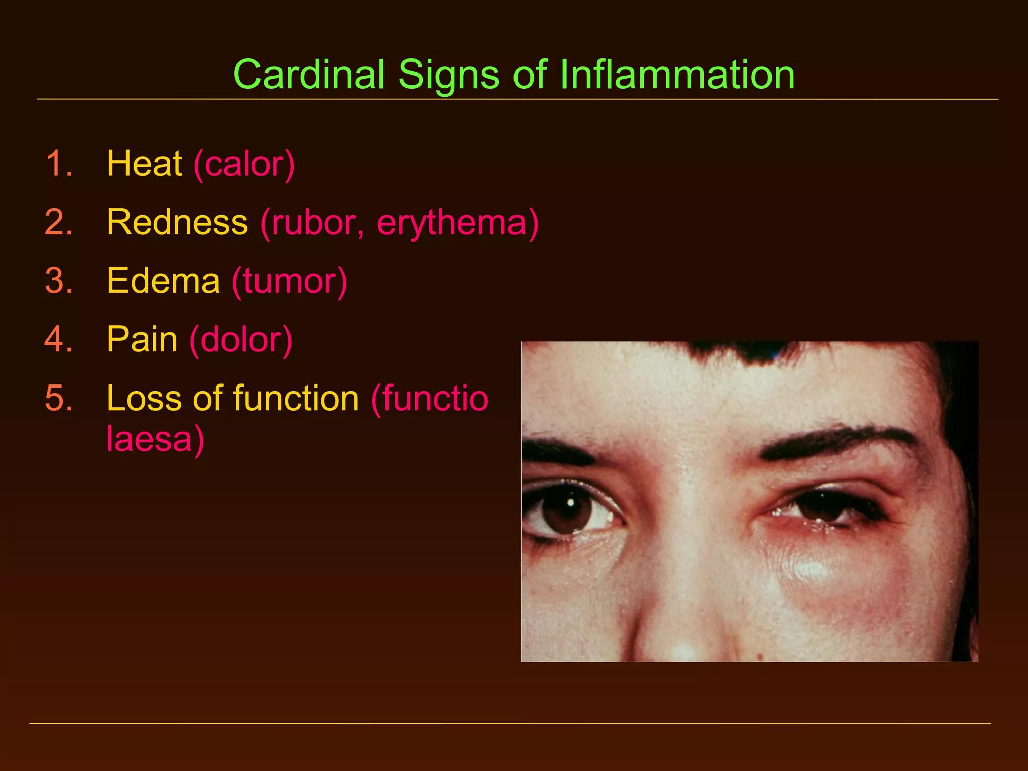 Cardinal Signs of Inflammation
1. Heat (calor)
2. Redness (rubor, erythema)
3. Edema (tumor)
4. Pain (dolor)
5. Loss of function (functio
laesa)

 
