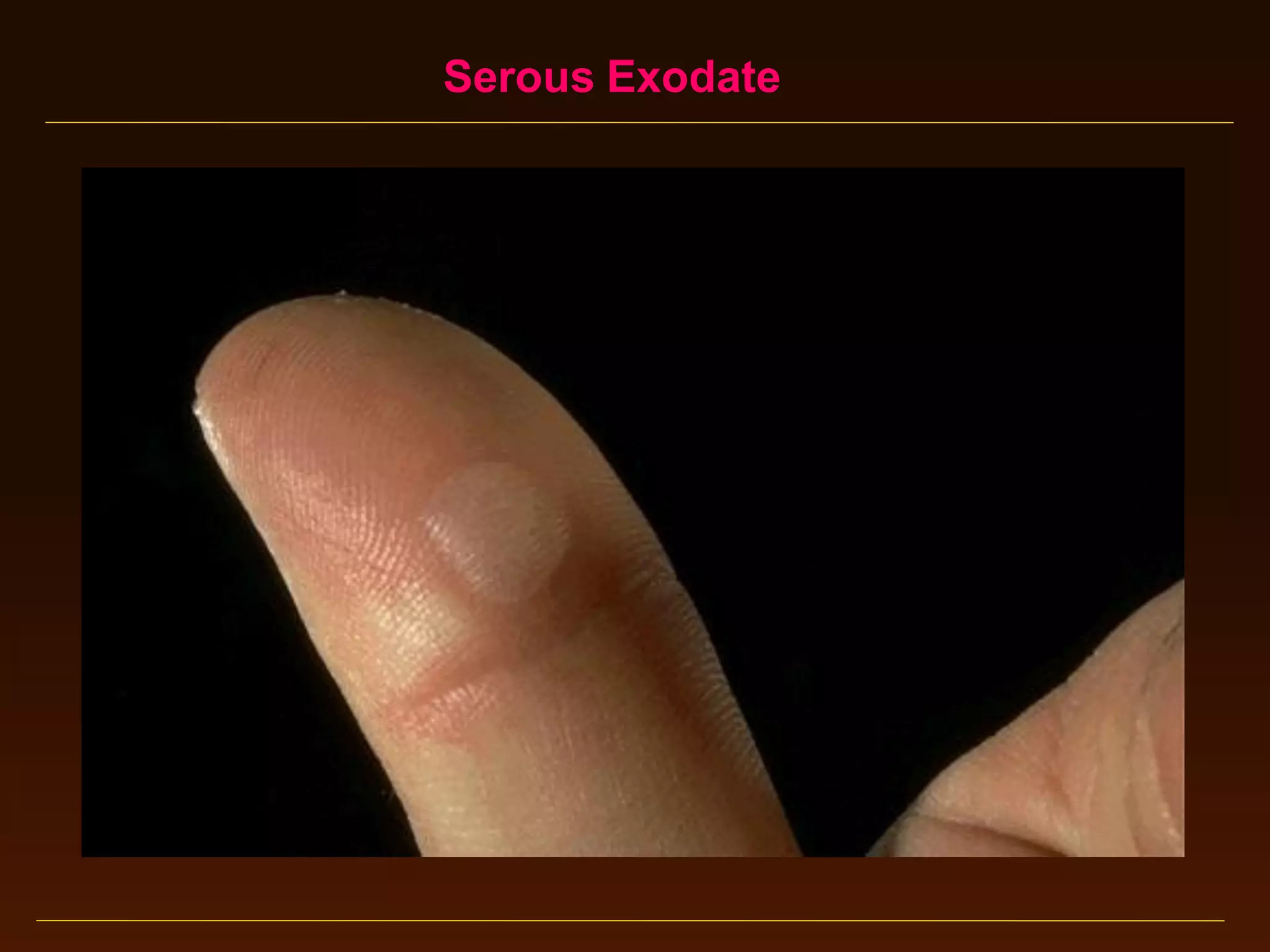 Serous Exodate

 