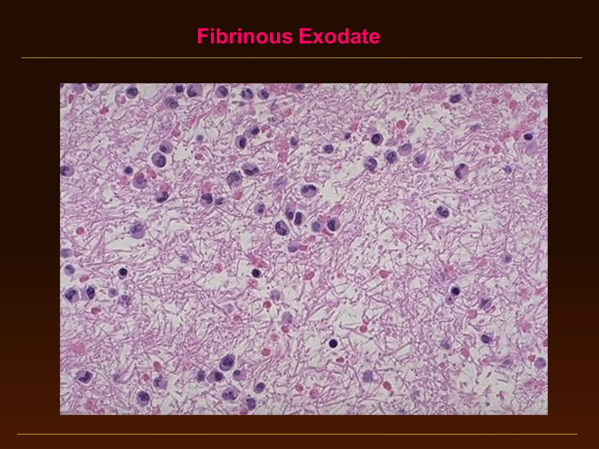 Fibrinous Exodate

 
