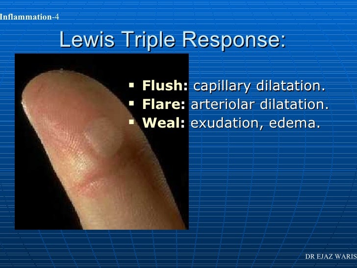 Inflammation Lecture 1 Dr Ejaz Waris