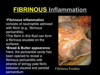 Fibrinous Exudate