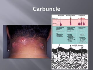 Carbuncle Radiopaedia Comprehensive Overview of Acute and Chronic Inflammation Types and ...