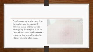 • An abscess may be discharged to
the surface due to increased
pressure inside or may require
drainage by the surgeon. Due to
tissue destruction, resolution does
not occur but instead healing by
fibrous scarring takes place.
 