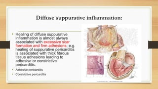 Inflammation 4 - inflammation pathology lecture series | PDF