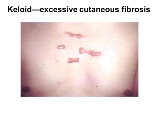 Keloid—excessive cutaneous fibrosis
 