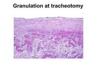 Granulation at tracheotomy
 