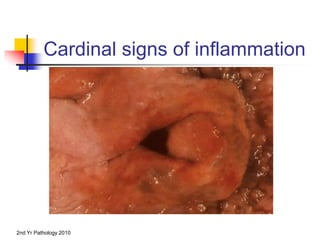 2nd Yr Pathology 2010
Cardinal signs of inflammation
 