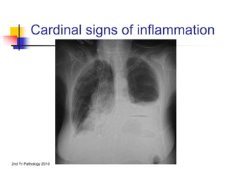 2nd Yr Pathology 2010
Cardinal signs of inflammation
 