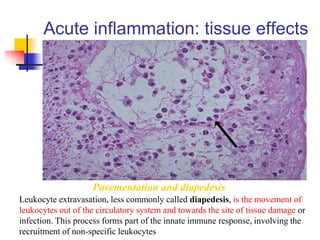Acute inflammation: tissue effects
Pavementation and diapedesis
Leukocyte extravasation, less commonly called diapedesis, is the movement of
leukocytes out of the circulatory system and towards the site of tissue damage or
infection. This process forms part of the innate immune response, involving the
recruitment of non-specific leukocytes
 