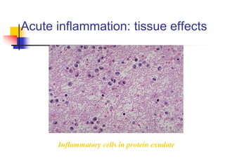 Acute inflammation: tissue effects
Inflammatory cells in protein exudate
 