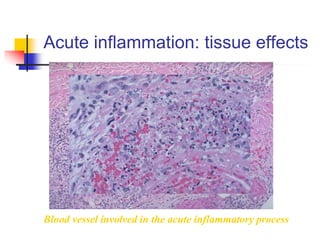 Acute inflammation: tissue effects
Blood vessel involved in the acute inflammatory process
 