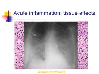 Acute inflammation: tissue effects
Bronchopneumonia
 